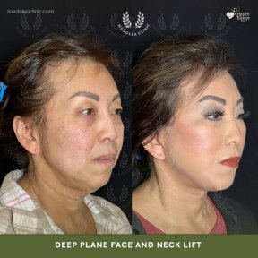 before-after photo deep-plane-facelift