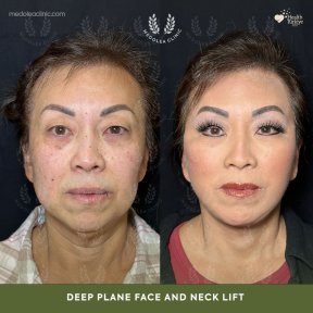 before-after photo deep-plane-facelift