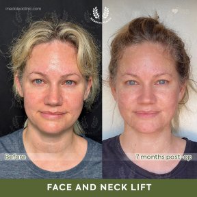 before-after photo deep-plane-facelift