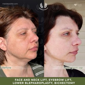 before-after photo deep-plane-facelift