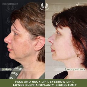 before-after photo deep-plane-facelift