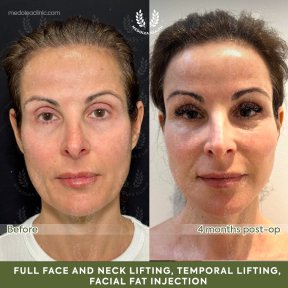 before-after photo deep-plane-facelift