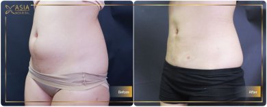 Результаты до и после подтяжки груди в Asia Cosmetic Hospital, виден улучшенный контур живота