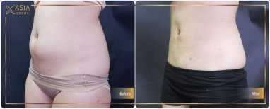 Результаты до и после подтяжки груди в Asia Cosmetic Hospital, виден улучшенный контур живота