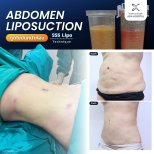Результаты липосакции живота до и после в Asia Cosmetic Hospital, техника SSS Lipo
