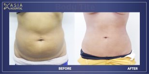 Результат до и после BodyTite в Asia Cosmetic Hospital – видимое контурирование живота