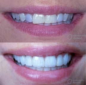 Before and after veneers at Ensenada Dental – smile transformation with natural results