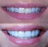 Before and after veneers at Ensenada Dental – smile transformation with natural results
