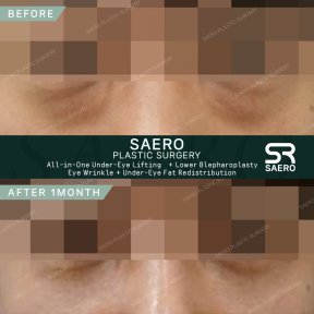До і після нижньої блефаропластики в SAERO Plastic Surgery, помітний ліфтинг під очима