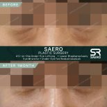 До і після нижньої блефаропластики в SAERO Plastic Surgery, помітний ліфтинг під очима