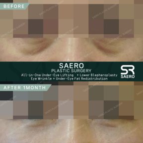 Результати до і після нижньої блефаропластики в SAERO Plastic Surgery, підтяжка повік