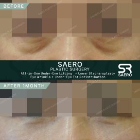 Результати до і після нижньої блефаропластики в SAERO Plastic Surgery, підтяжка повік