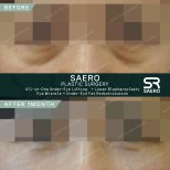 Результати до і після нижньої блефаропластики в SAERO Plastic Surgery, підтяжка повік