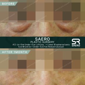 Результати до і після нижньої блефаропластики в SAERO Plastic Surgery, підтяжка повік
