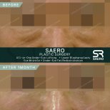 Результати нижньої блефаропластики в SAERO Plastic Surgery, помітний ліфтинг під очима