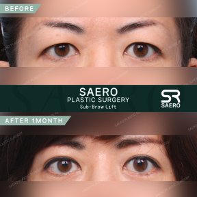 Результати до і після суббров ліфтингу в SAERO Plastic Surgery, покращення повік