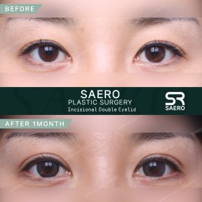 Результати до і після інцизійної блефаропластики в клініці SAERO Plastic Surgery