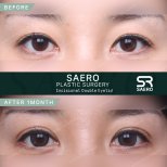 Результати до і після інцизійної блефаропластики в клініці SAERO Plastic Surgery