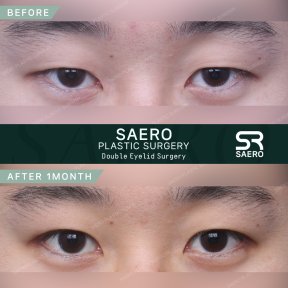 Результати до і після блефаропластики в SAERO Plastic Surgery, 1 місяць після операції