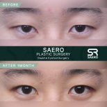 Результати до і після блефаропластики в SAERO Plastic Surgery, 1 місяць після операції