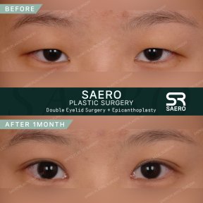 Результати до і після блефаропластики та епікантопластики в SAERO Plastic Surgery