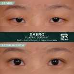 Результати до і після блефаропластики та епікантопластики в SAERO Plastic Surgery