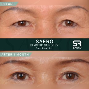 Результати до і після суббров ліфтингу в SAERO Plastic Surgery, помітне омолодження повік