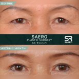 Результати до і після суббров ліфтингу в SAERO Plastic Surgery, помітне омолодження повік