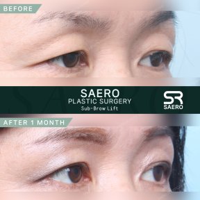 Результати до і після суббров ліфтингу в SAERO Plastic Surgery, покращення повік