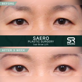 Результати до і після суббров ліфтингу в SAERO Plastic Surgery, покращення повік