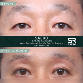 Результати до і після блефаропластики та підтяжки брів у SAERO Plastic Surgery