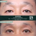Результати до і після блефаропластики та підтяжки брів у SAERO Plastic Surgery