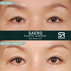 Результати до і після суббровліфтингу в SAERO Plastic Surgery, омолодження повік