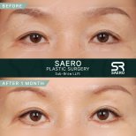Результати до і після суббровліфтингу в SAERO Plastic Surgery, омолодження повік