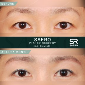 Результати до і після суббров ліфтингу в SAERO Plastic Surgery, покращення повік