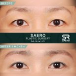 Результати до і після суббров ліфтингу в SAERO Plastic Surgery, покращення повік