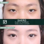 Результат до і після блефаропластики в SAERO Plastic Surgery, 1 місяць після операції