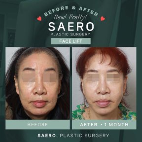 Результати до і після підтяжки обличчя в SAERO Plastic Surgery, помітне омолодження