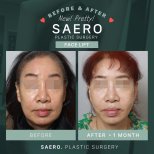 Результати до і після підтяжки обличчя в SAERO Plastic Surgery, помітне омолодження