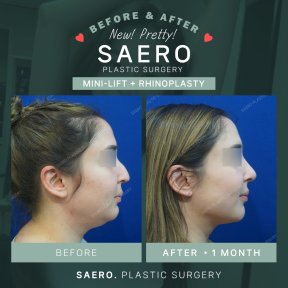 Результати міні-ліфтингу та ринопластики в SAERO Plastic Surgery, покращено контур обличчя
