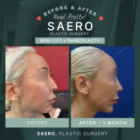 Результати міні-ліфтингу та ринопластики до і після в SAERO Plastic Surgery, корекція обличчя
