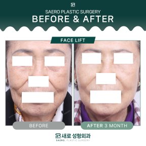 Результати до і після підтяжки обличчя в SAERO Plastic Surgery, омолодження через 3 місяці