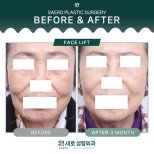 Результати до і після підтяжки обличчя в SAERO Plastic Surgery, омолодження через 3 місяці