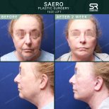 Результати до і після підтяжки обличчя в SAERO Plastic Surgery, омолодження через 2 тижні