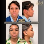 Before and after deep plane face and neck lift with endotine forehead lift at ID Clinic Bangkok