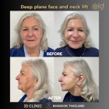 Before and after deep plane face and neck lift results at ID Clinic Bangkok, visible rejuvenation