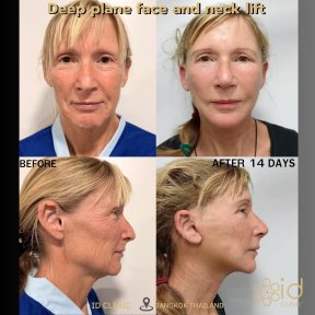 Before and after deep plane face and neck lift results at ID Clinic Bangkok, 14 days post-op