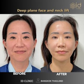Before and after deep plane face and neck lift results at ID Clinic Bangkok, rejuvenation visible