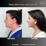 Before and after deep plane face and neck lift results at ID Clinic Bangkok, visible rejuvenation