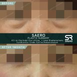 Результати до і після нижньої блефаропластики в SAERO Plastic Surgery, підтяжка повік